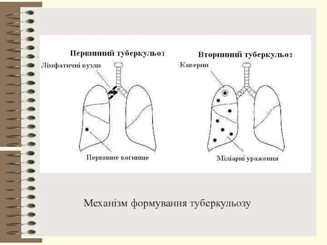 Механізм формування туберкульозу