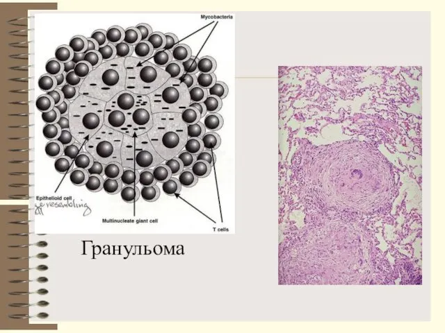 Гранульома