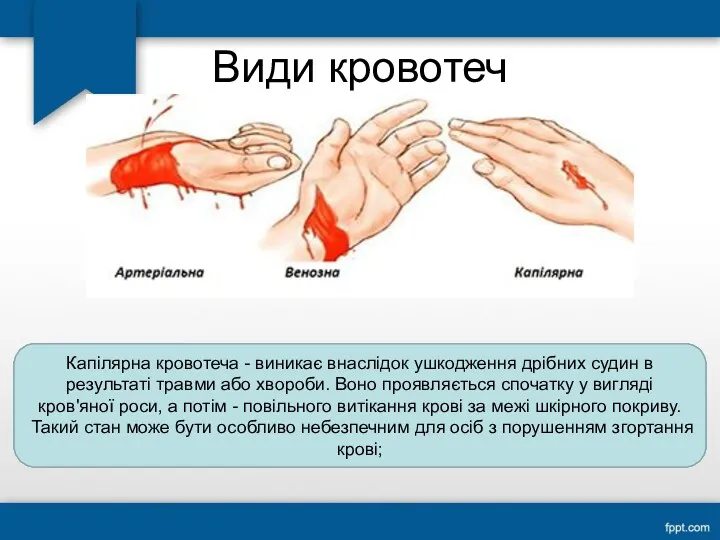 Види кровотеч Артеріальна кровотеча є результатом пошкодження аорти, стегнової та