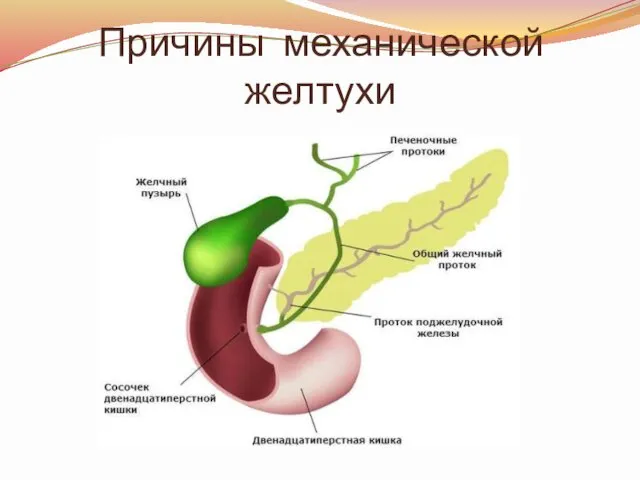 Причины механической желтухи