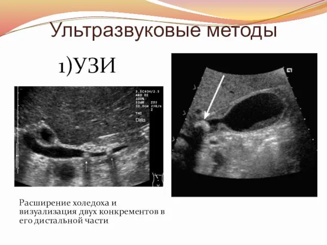 Ультразвуковые методы Расширение холедоха и визуализация двух конкрементов в его дистальной части 1)УЗИ