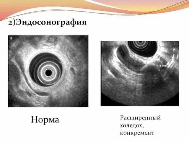 2)Эндосонография Норма Расширенный холедох, конкремент