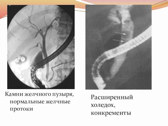 Камни желчного пузыря, нормальные желчные протоки Расширенный холедох, конкременты