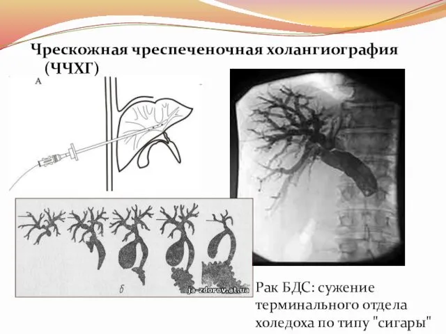 Чрескожная чреспеченочная холангиография (ЧЧХГ) Рак БДС: сужение терминального отдела холедоха по типу "сигары"