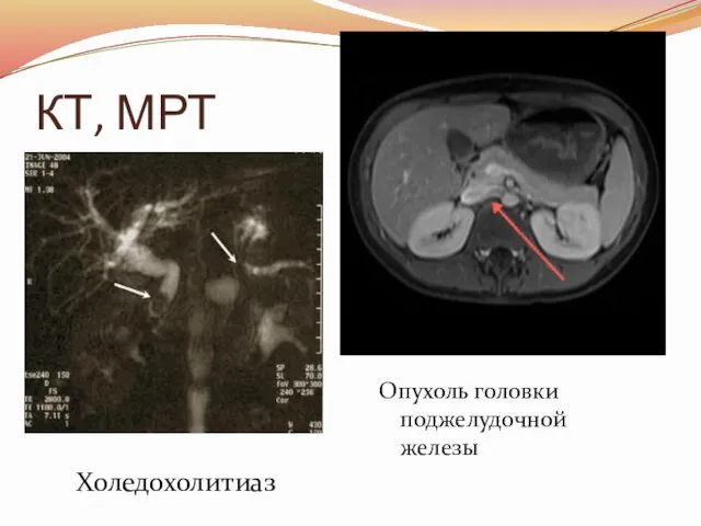 КТ, МРТ Опухоль головки поджелудочной железы Холедохолитиаз