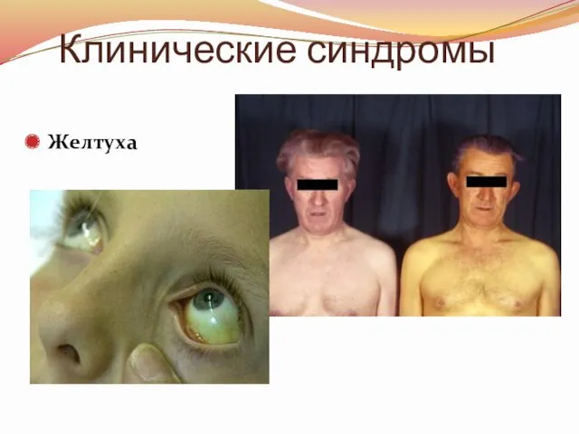 Клинические синдромы Желтуха