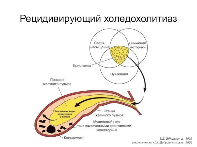 Рецидивирующий холедохолитиаз L.E. Bilhartz et al., 1998 с изменениями С.А. Дадвани с соавт., 2000