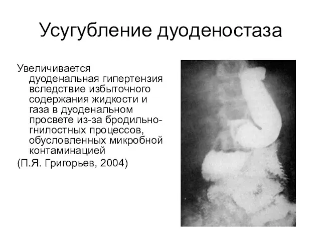 Усугубление дуоденостаза Увеличивается дуоденальная гипертензия вследствие избыточного содержания жидкости и