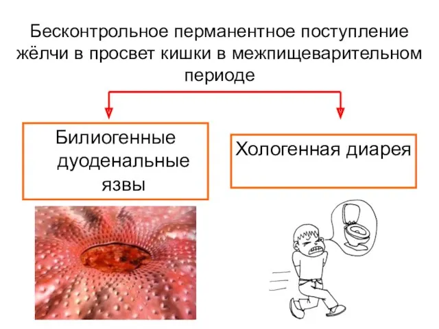 Бесконтрольное перманентное поступление жёлчи в просвет кишки в межпищеварительном периоде Билиогенные дуоденальные язвы Хологенная диарея