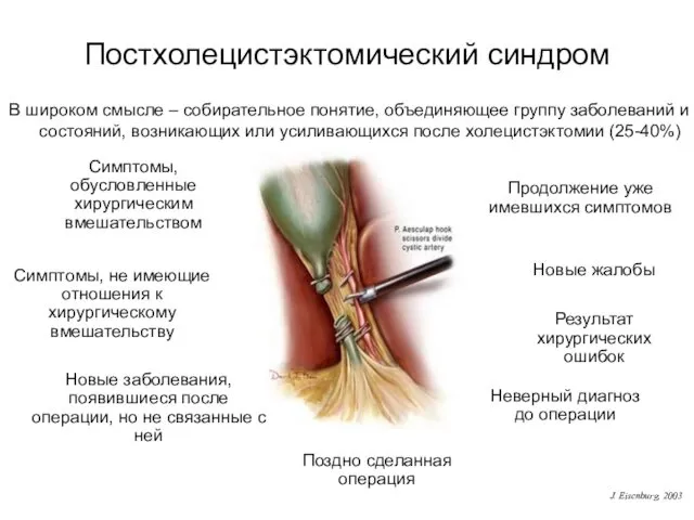 Постхолецистэктомический синдром Продолжение уже имевшихся симптомов Новые жалобы Симптомы, обусловленные