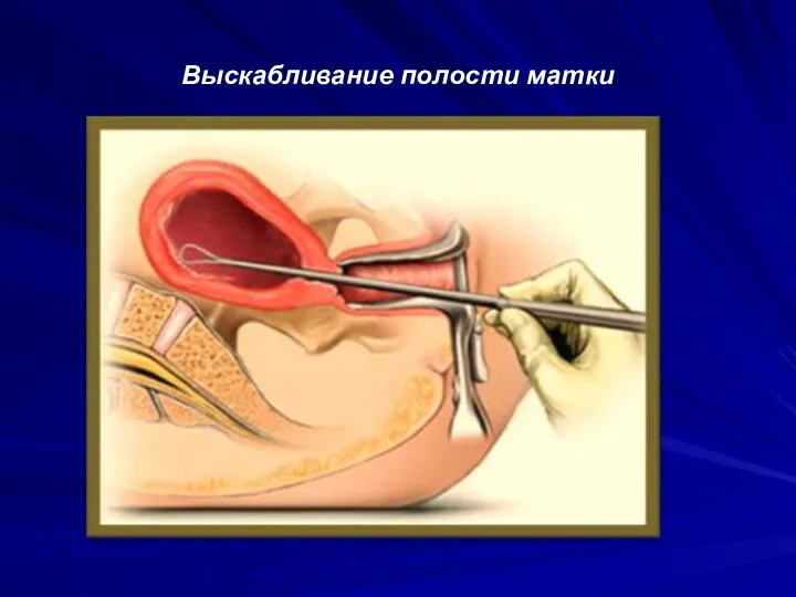 Выскабливание полости матки