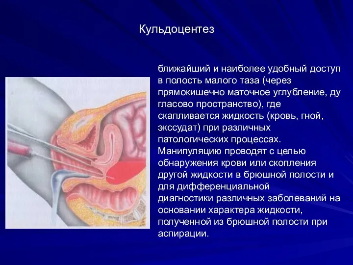 Кульдоцентез ближайший и наиболее удобный доступ в полость малого таза