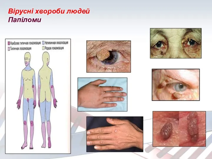 Вірусні хвороби людей Папіломи