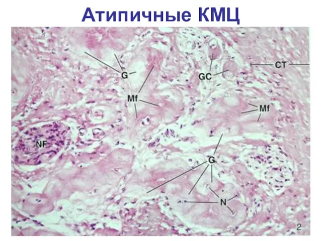 Атипичные КМЦ