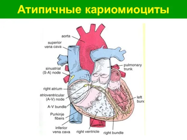 Атипичные кариомиоциты