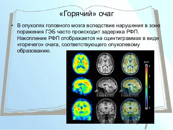 «Горячий» очаг В опухолях головного мозга вследствие нарушения в зоне поражения ГЭБ часто