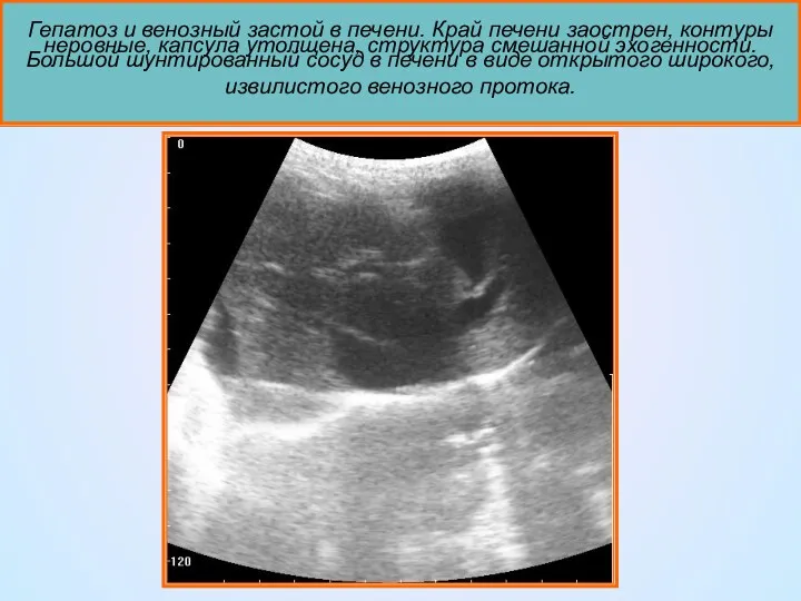 Гепатоз и венозный застой в печени. Край печени заострен, контуры