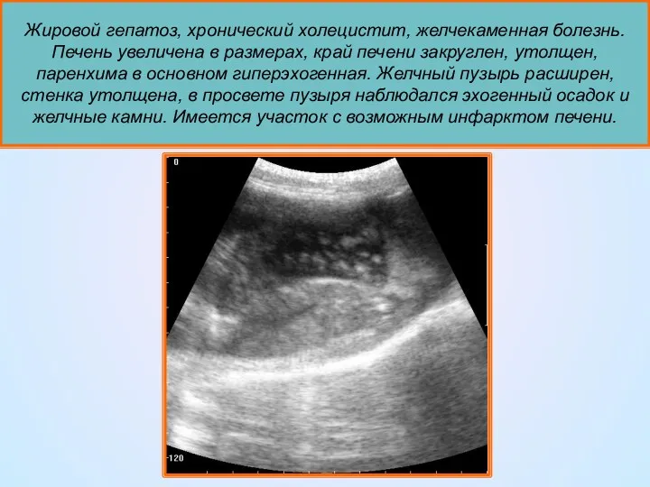 Жировой гепатоз, хронический холецистит, желчекаменная болезнь. Печень увеличена в размерах,