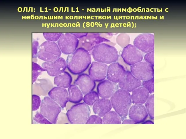 ОЛЛ: L1- ОЛЛ L1 - малый лимфобласты с небольшим количеством цитоплазмы и нуклеолей (80% у детей);