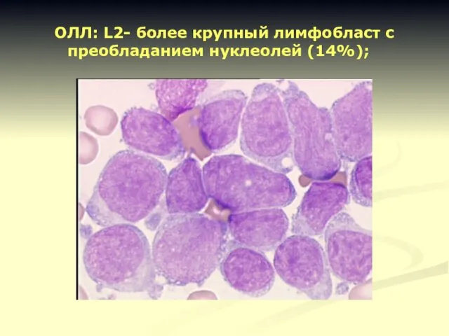 ОЛЛ: L2- более крупный лимфобласт с преобладанием нуклеолей (14%);