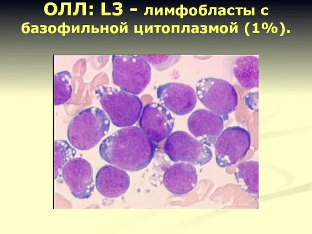 ОЛЛ: L3 - лимфобласты с базофильной цитоплазмой (1%).