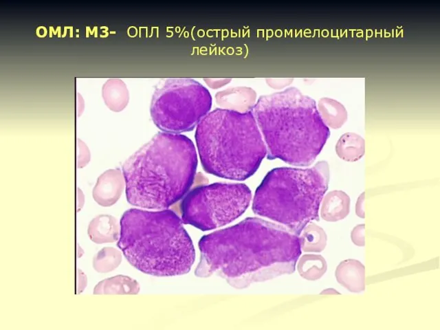 ОМЛ: М3- ОПЛ 5%(острый промиелоцитарный лейкоз)