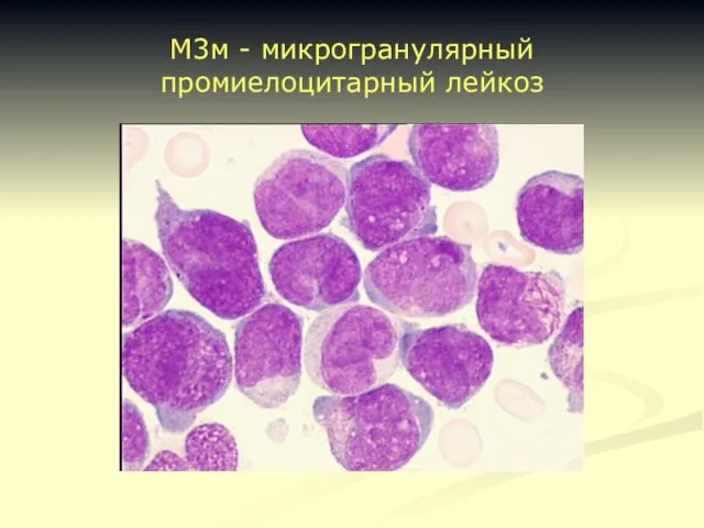 М3м - микрогранулярный промиелоцитарный лейкоз