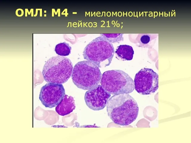 ОМЛ: М4 - миеломоноцитарный лейкоз 21%;