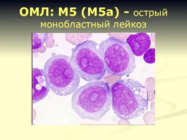 ОМЛ: М5 (М5а) - острый монобластный лейкоз