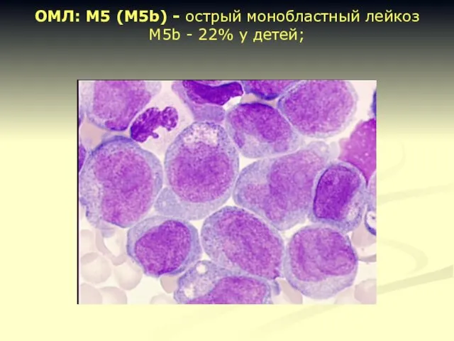 ОМЛ: М5 (М5b) - острый монобластный лейкоз М5b - 22% у детей;