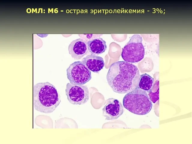 ОМЛ: M6 - острая эритролейкемия - 3%;