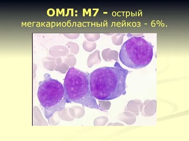 ОМЛ: M7 - острый мегакариобластный лейкоз - 6%.