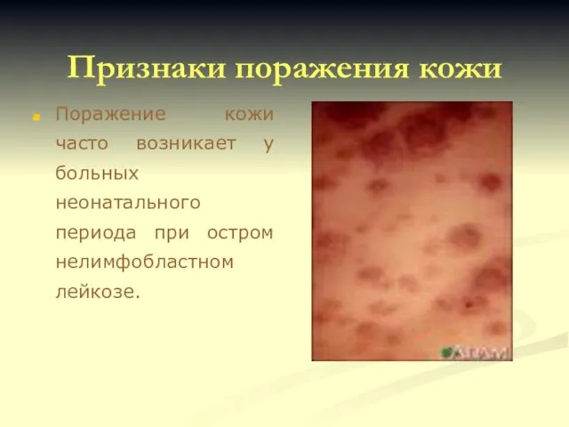 Признаки поражения кожи Поражение кожи часто возникает у больных неонатального периода при остром нелимфобластном лейкозе.