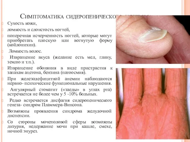 Симптоматика сидеропенического синдрома. Сухость кожи, ломкость и слоистость ногтей, поперечная исчерченность ногтей, которые