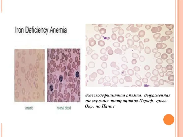 Железодефицитная анемия. Выраженная гипохромия эритроцитов.Периф. кровь. Окр. по Паппе