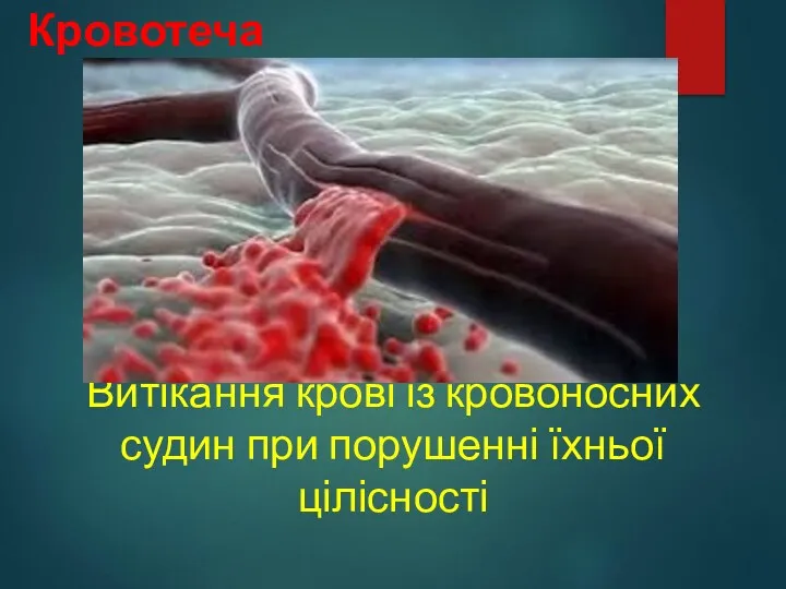 Кровотеча Витікання крові із кровоносних судин при порушенні їхньої цілісності