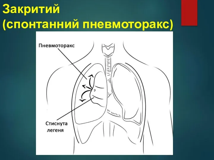 Закритий (спонтанний пневмоторакс)