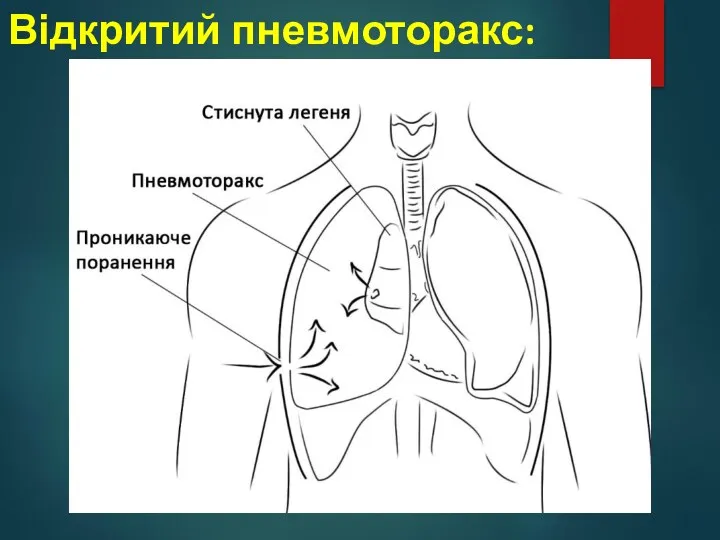 Відкритий пневмоторакс: