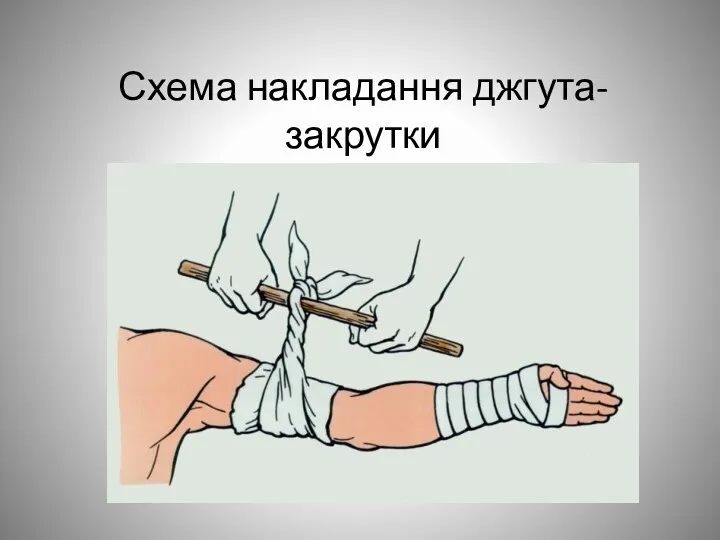 Схема накладання джгута- закрутки