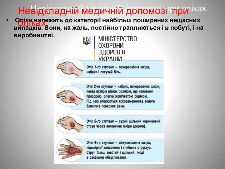 Невідкладній медичній допомозі при опіках Опіки належать до категорії найбільш