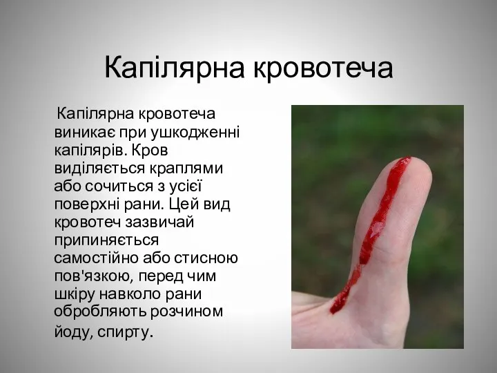 Капілярна кровотеча Капілярна кровотеча виникає при ушкодженні капілярів. Кров виділяється