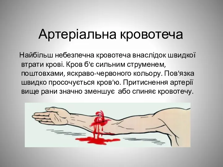 Артеріальна кровотеча Найбільш небезпечна кровотеча внаслідок швидкої втрати крові. Кров