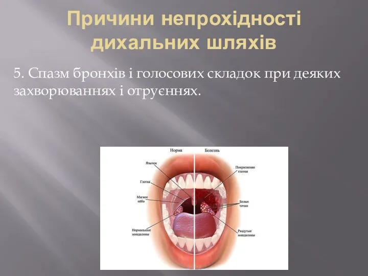 Причини непрохідності дихальних шляхів 5. Спазм бронхів і голосових складок при деяких захворюваннях і отруєннях.