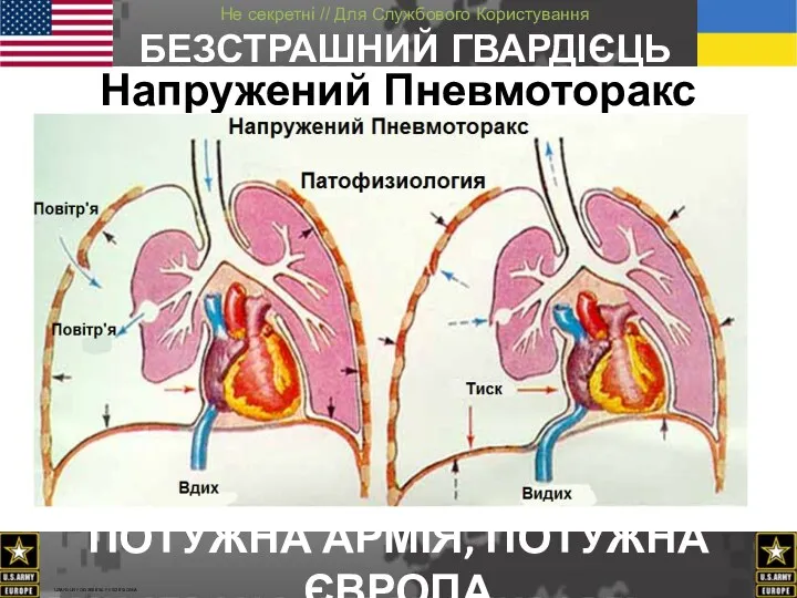 Напружений Пневмоторакс