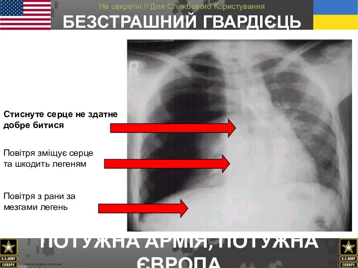 Повітря зміщує серце та шкодить легеням Стиснуте серце не здатне