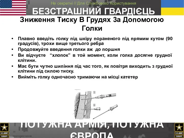 Зниження Tиску B Грудях 3а Допомогою Голки Плавно введіть голку