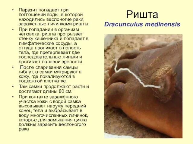 Ришта Dracunculus medinensis Паразит попадает при поглощении воды, в которой