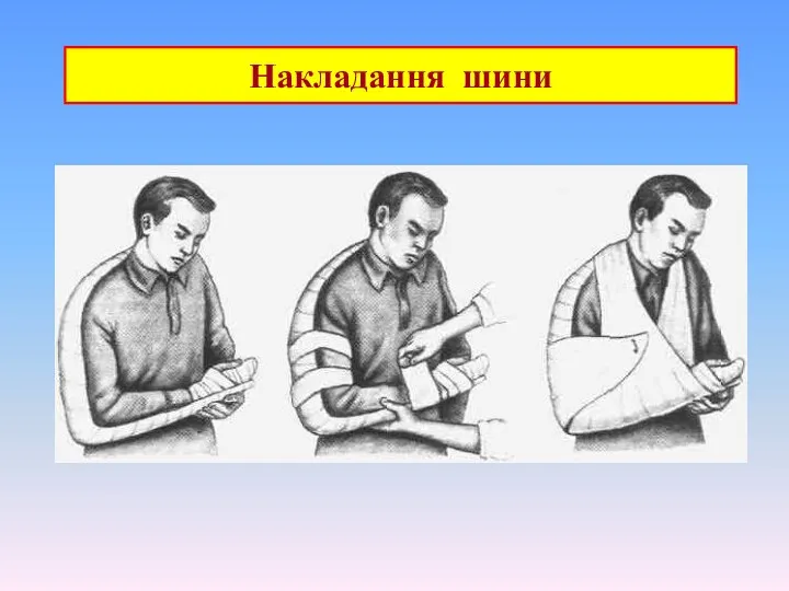 Накладання шини