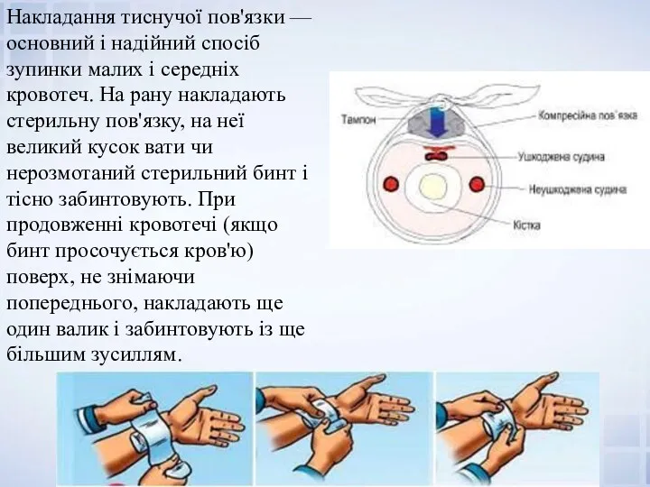 Накладання тиснучої пов'язки — основний і надійний спосіб зупинки малих