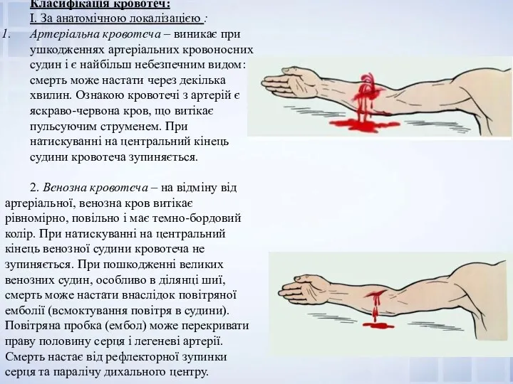 Класифікація кровотеч: І. За анатомічною локалізацією : Артеріальна кровотеча –